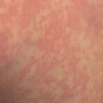 Pele com lesões temporárias devido a alergia ao frio