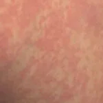 Pele com lesões temporárias devido a alergia ao frio