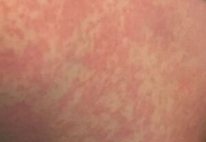 Pele com lesões temporárias devido a alergia ao frio