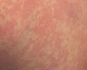 Pele com lesões temporárias devido a alergia ao frio