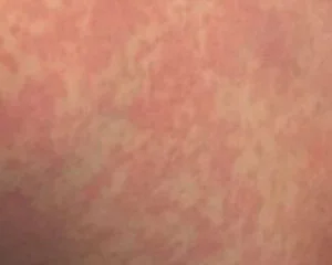 Pele com lesões temporárias devido a alergia ao frio