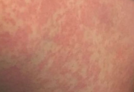 Pele com lesões temporárias devido a alergia ao frio