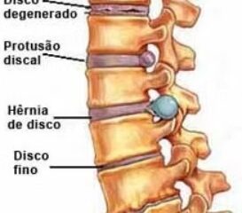 Exemplos de problemas de discos. Fonte: divulgação
